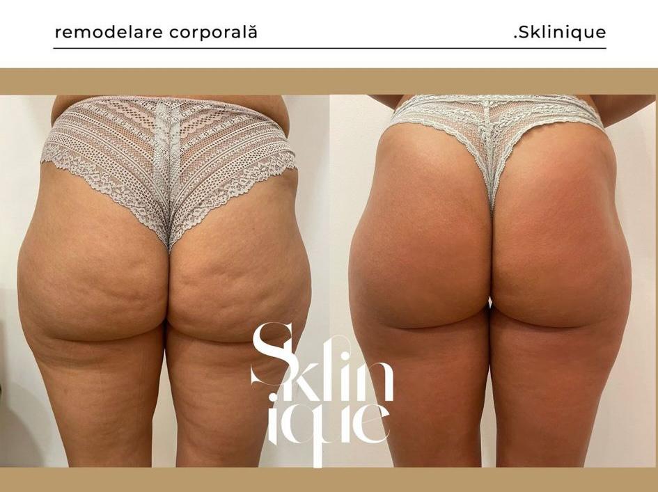 before after fese