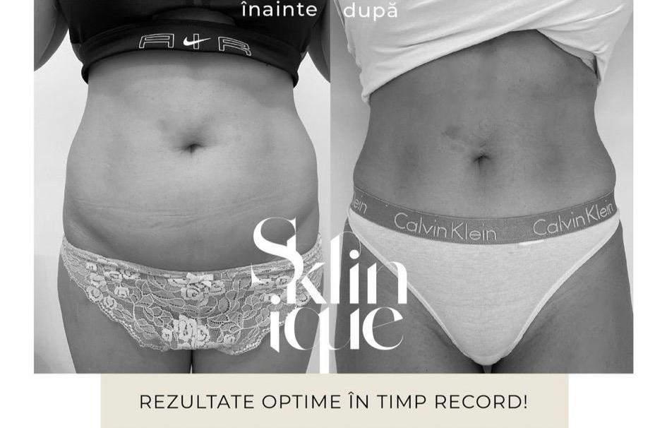 before after abdomen 2