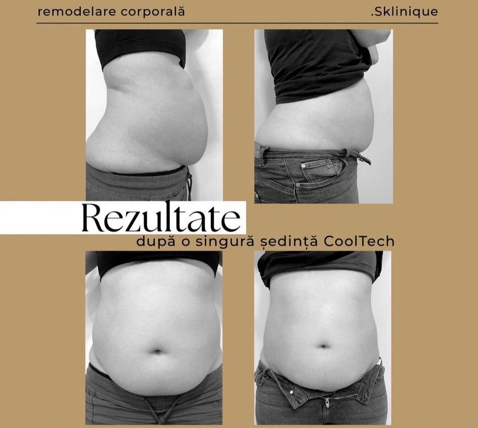 before after abdomen